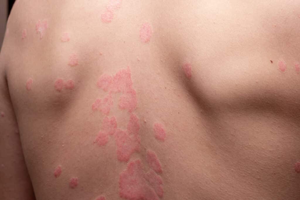 psoriasis