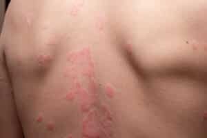 psoriasis
