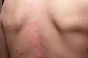 psoriasis